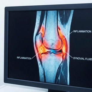Inflammation Suppression